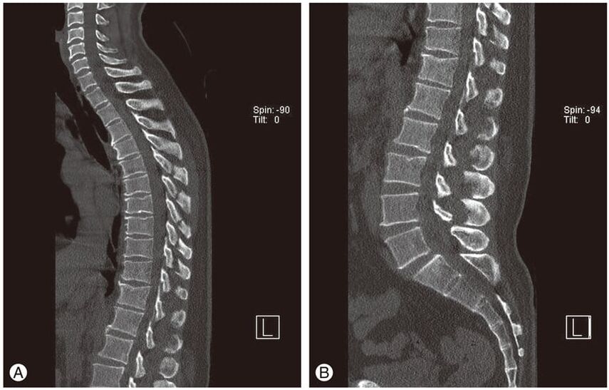 Deformácia medzistavcových platničiek na snímkach MRI pri hrudnej osteochondróze