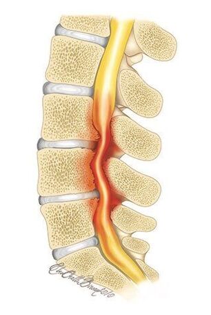Pri osteochondróze hrudnej chrbtice dochádza k stlačeniu miechového kanála