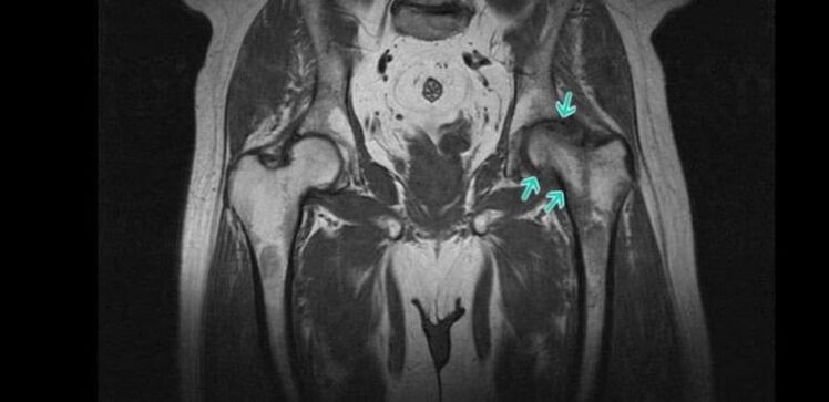 Osteoartróza bedrového kĺbu na MRI