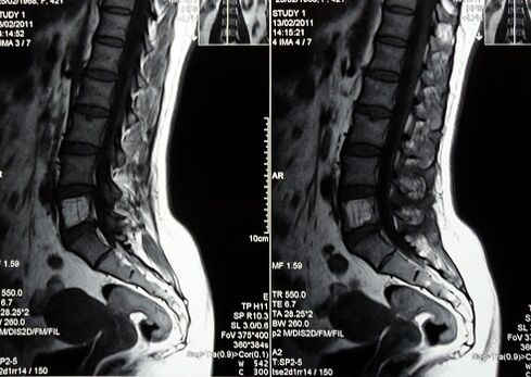 MRI lumbosakrálnej chrbtice na diagnostiku bolesti dolnej časti chrbta